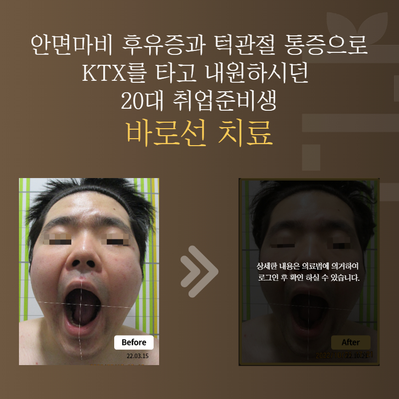 안면마비 후유증과 턱관절 통증으로 KTX를 타고 내원하시던 20대 취업준비생 바로선치료