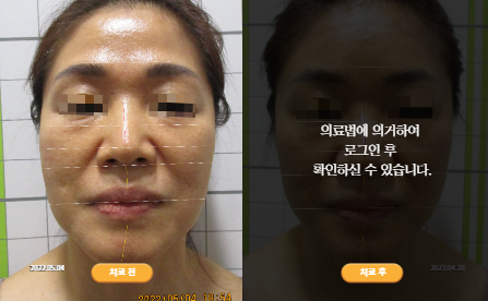 바로선치료 [50대 여성] 안면비대칭