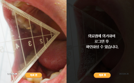 바로선치료 [50대 여성] 턱관절