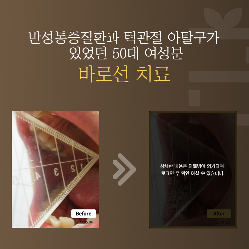 만성통증질환과 턱관절 아탈구가 있었던 50대 여성분 바로선치료
