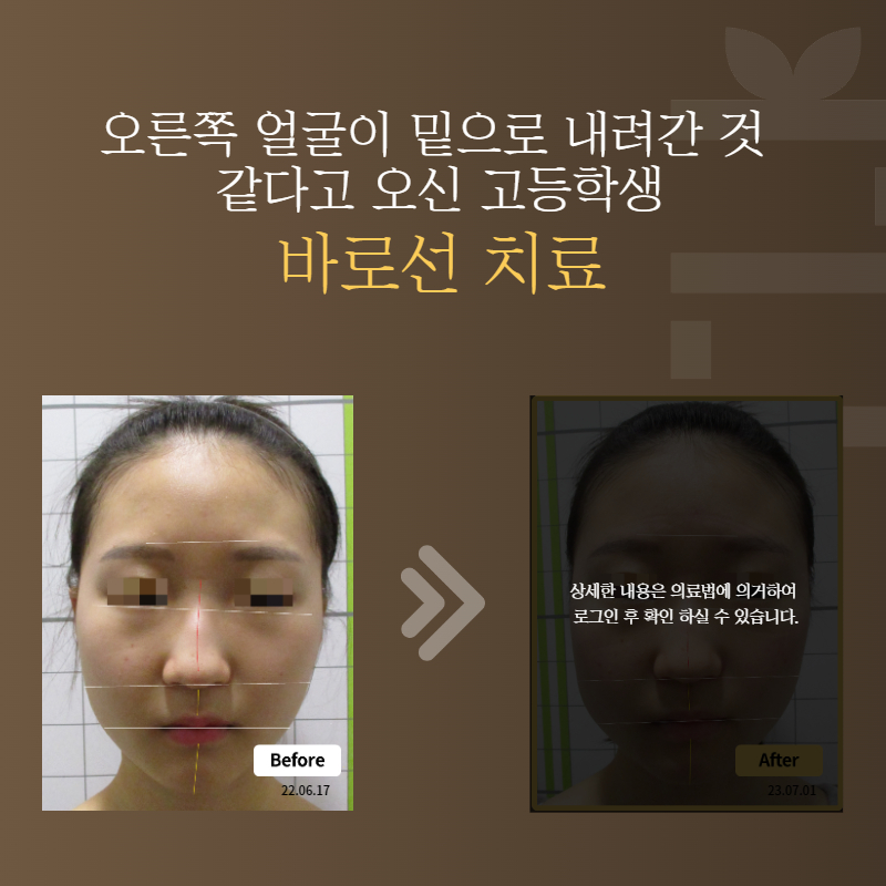 오른쪽 얼굴이 밑으로 내려간 것 같다고 오신 고등학생 바로선치료