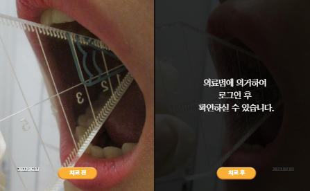 바로선치료 [10대 여성] 턱관절
