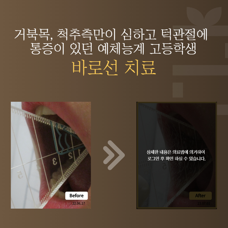 거북목, 척추측만이 심하고 턱관절에 통증이 있던 예체능계 고등학생 바로선치료