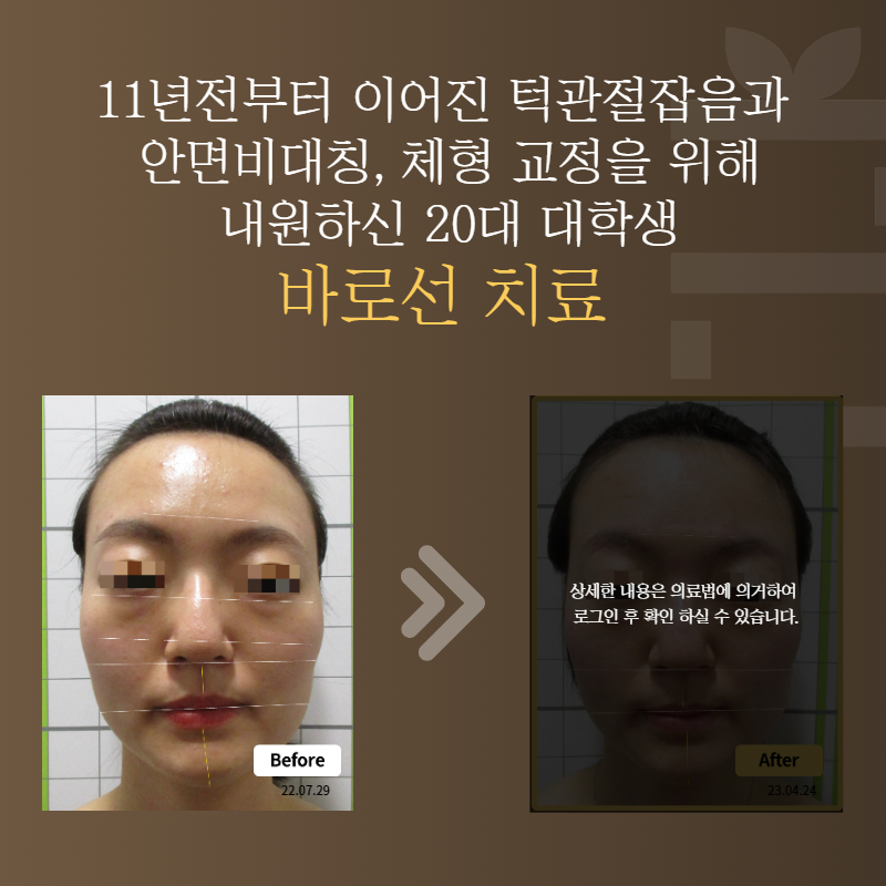 11년전부터 이어진 턱관절잡음과 안면비대칭, 체형 교정을 위해 내원하신 20대 대학생 바로선치료