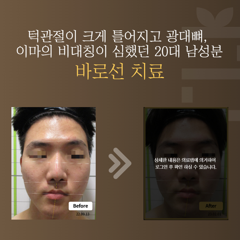 턱관절이 크게 틀어지고 광대뼈, 이마의 비대칭이 심했던 20대 남성분 바로선치료