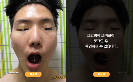 바로선치료 [20대 남성] 턱관절