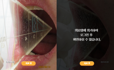 바로선치료 [20대 남성] 턱관절