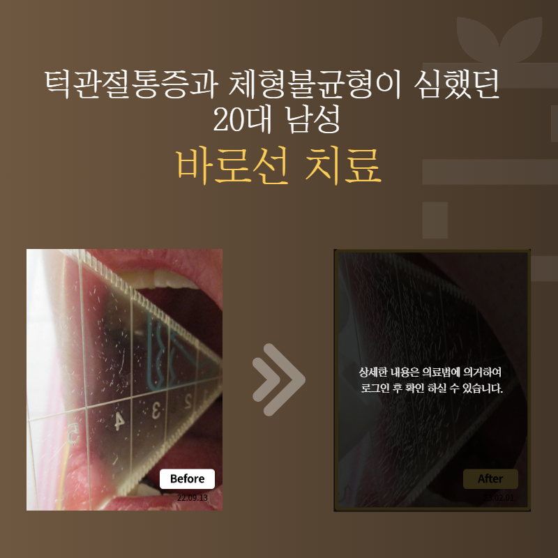 턱관절통증과 체형불균형이 심했던 20대 남성 바로선치료