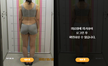 바로선치료 [20대 여성] 안면비대칭