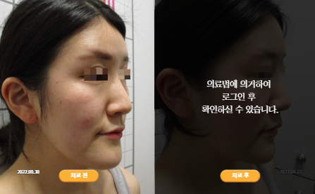 바로선치료 [20대 여성] 안면비대칭