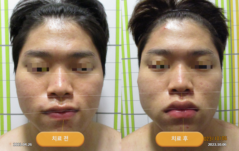한쪽 얼굴이 유난히 커져서 내원하셨던 20대 남성 바로선치료 사진 4