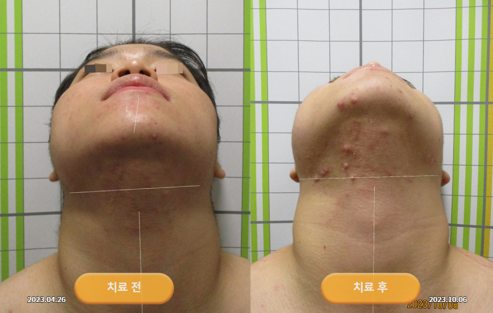 한쪽 얼굴이 유난히 커져서 내원하셨던 20대 남성 바로선치료 사진 3