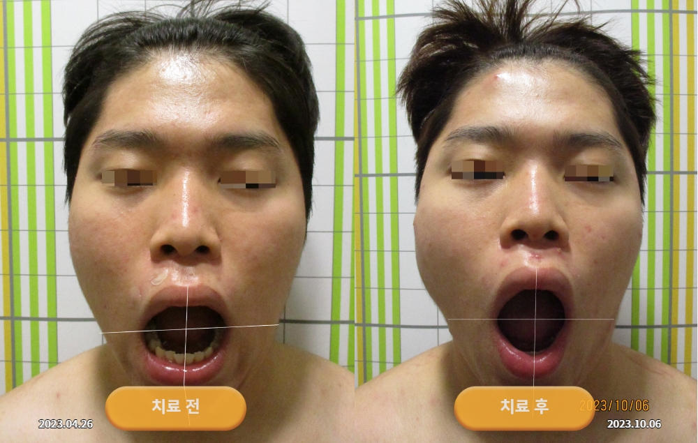 한쪽 얼굴이 유난히 커져서 내원하셨던 20대 남성 바로선치료 사진 2