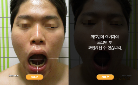 바로선치료 [20대 남성] 턱관절