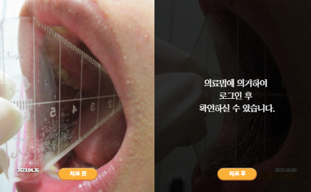 바로선치료 [20대 남성] 턱관절
