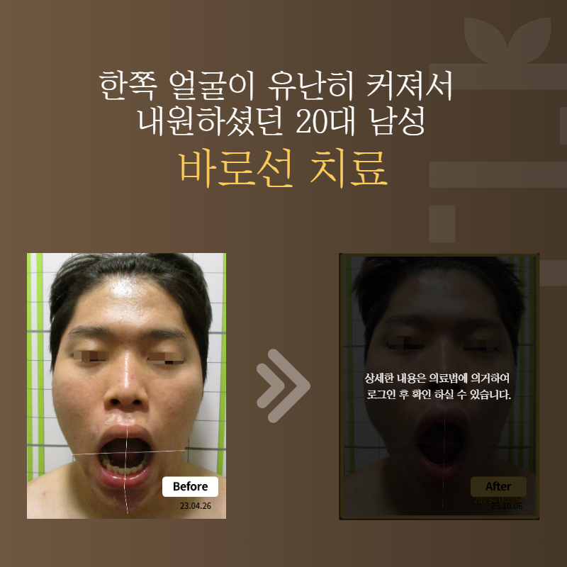 한쪽 얼굴이 유난히 커져서 내원하셨던 20대 남성 바로선치료