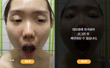 바로선치료 [20대 여성] 턱관절