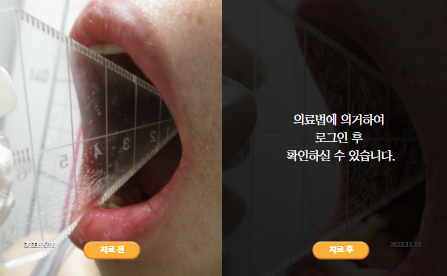 바로선치료 [20대 여성] 턱관절