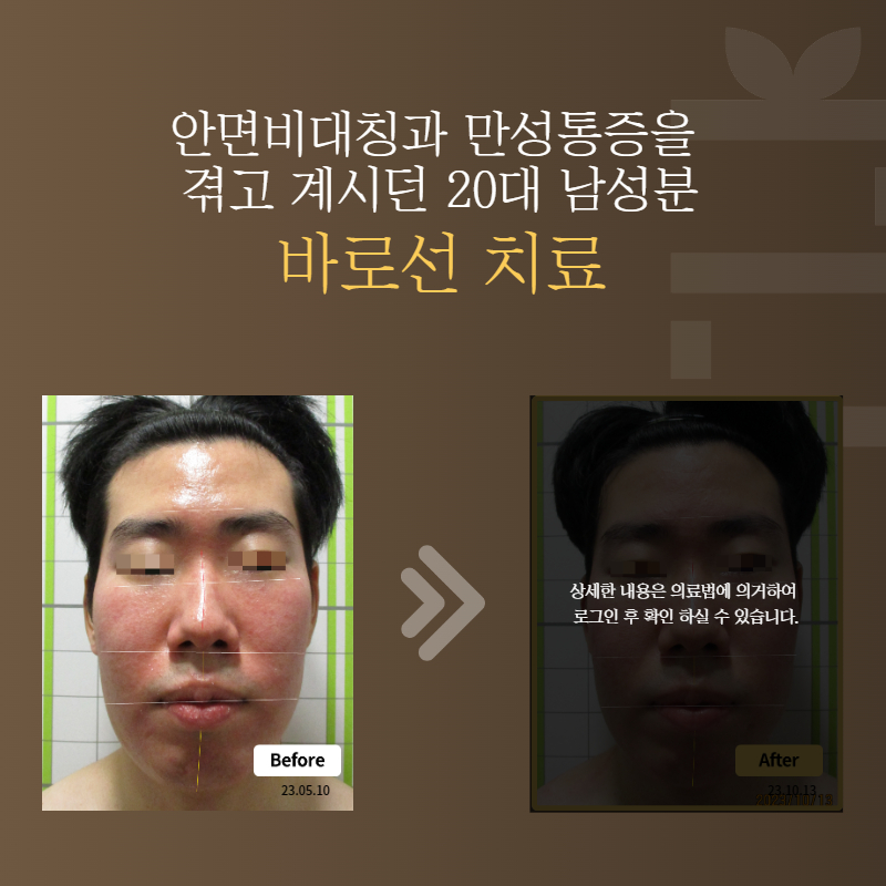 안면비대칭과 만성통증을 겪고 계시던 20대 남성분 바로선치료