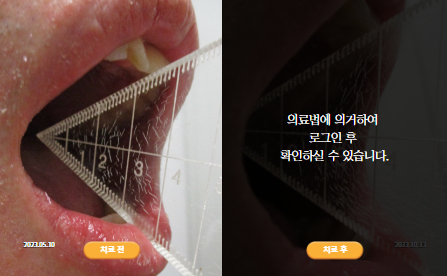 바로선치료 [20대 남성] 턱관절