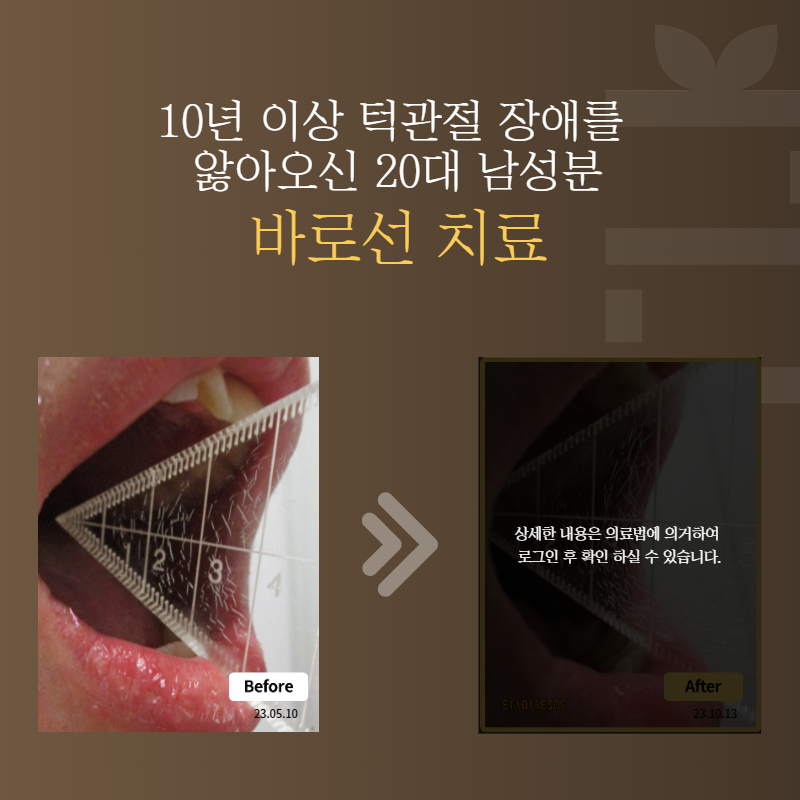 10년 이상 턱관절 장애를 앓아오신 20대 남성분 바로선치료