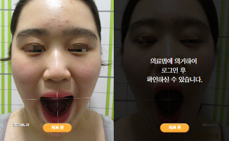 바로선치료 [20대 여성] 턱관절