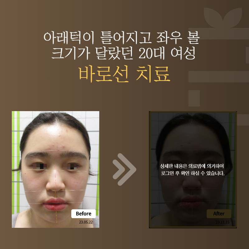 아래턱이 틀어지고 좌우 볼 크기가 달랐던 20대 여성 바로선치료