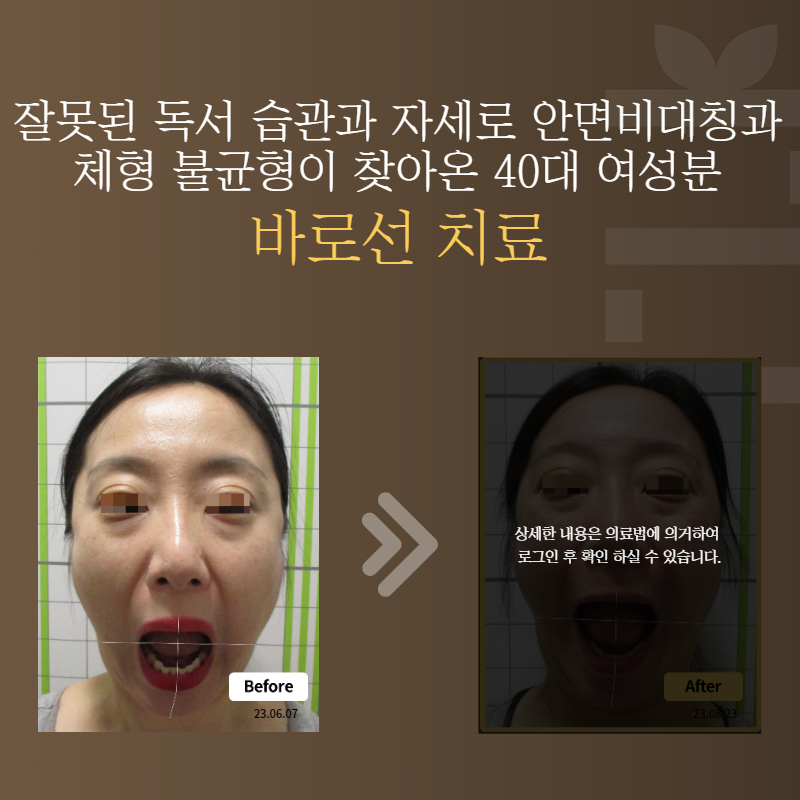잘못된 독서 습관과 자세로 안면비대칭과 체형 불균형이 찾아온 40대 여성분 바로선치료