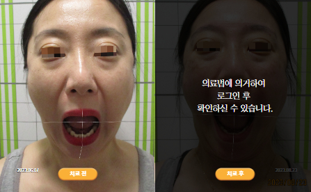 바로선치료 [40대 여성] 턱관절