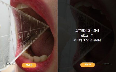 바로선치료 [40대 여성] 턱관절