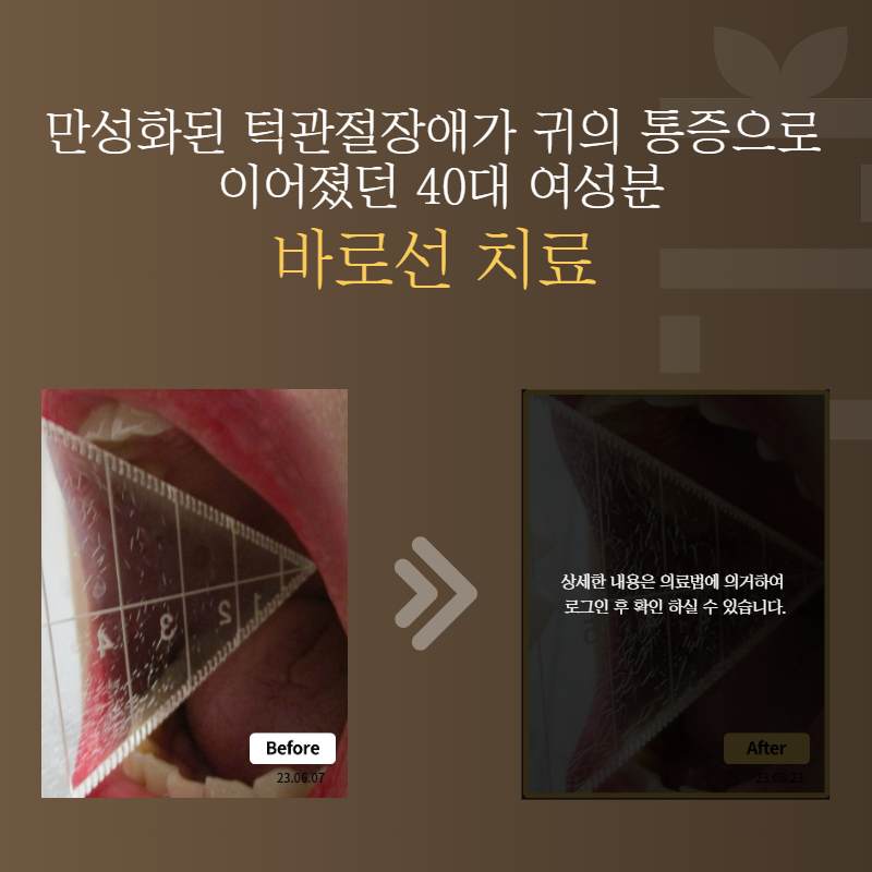 만성화된 턱관절장애가 귀의 통증으로 이어졌던 40대 여성분 바로선치료