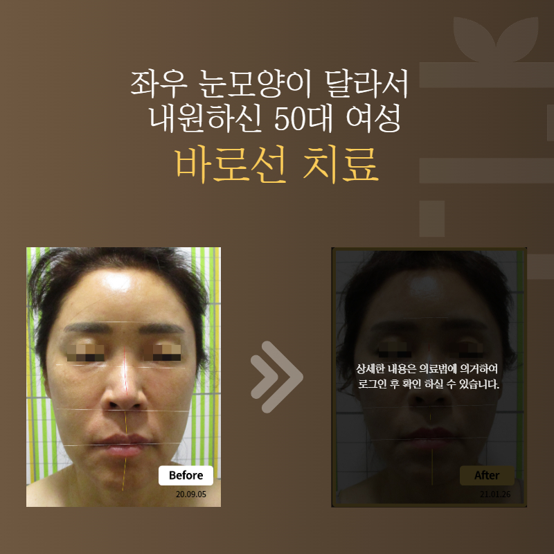 좌우 눈모양이 달라서 내원하신 50대 여성 바로선치료