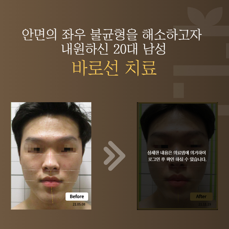 안면의 좌우 불균형을 해소하고자 내원하신 20대 남성 바로선치료