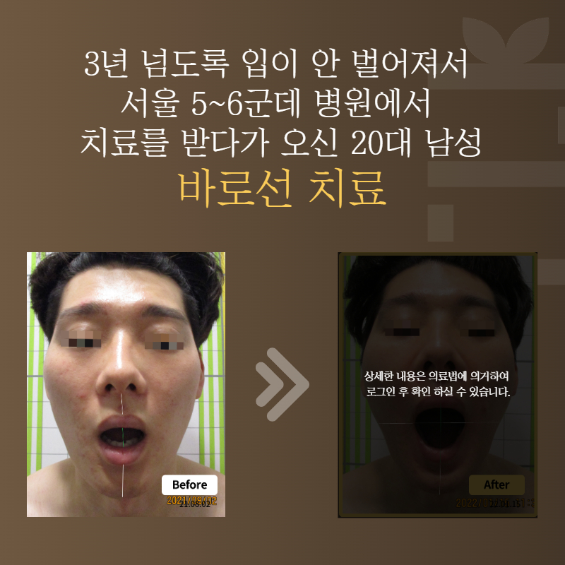 3년 넘도록 입이 안 벌어져서 서울 5~6군데 병원에서 치료를 받다가 오신 20대 남성 바로선치료