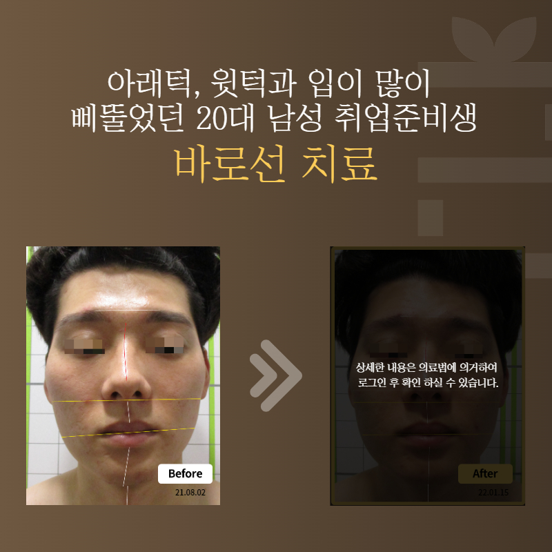 아래턱, 윗턱과 입이 많이 삐뚤었던 20대 남성 취업준비생 바로선치료