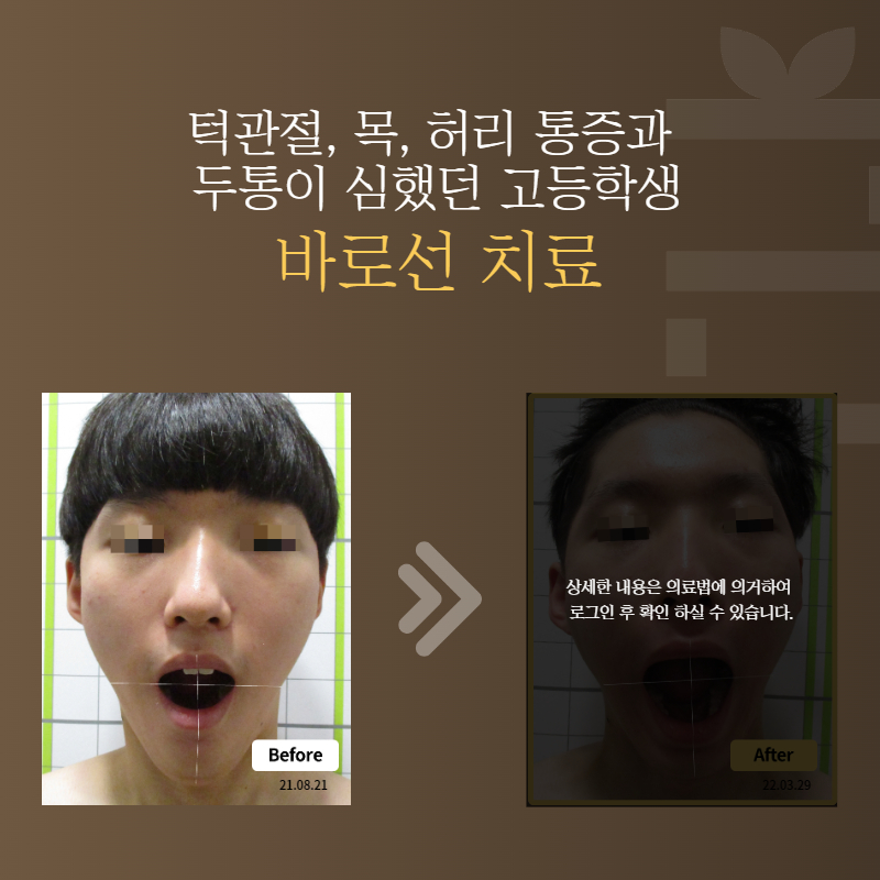 턱관절, 목, 허리 통증과 두통이 심했던 고등학생 바로선치료