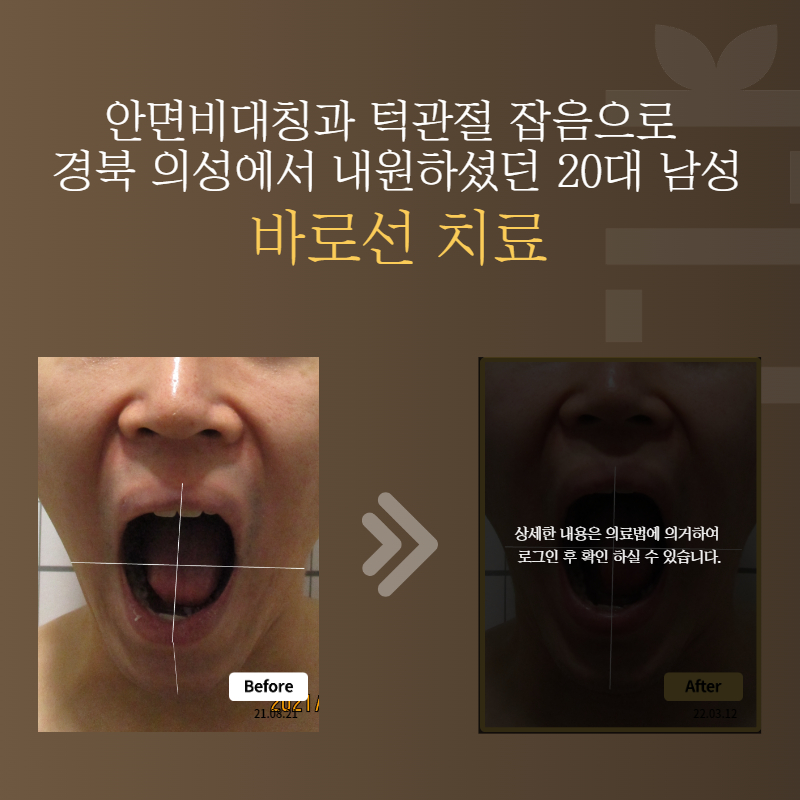 안면비대칭과 턱관절 잡음으로 경북 의성에서 내원하셨던 20대 남성 바로선치료