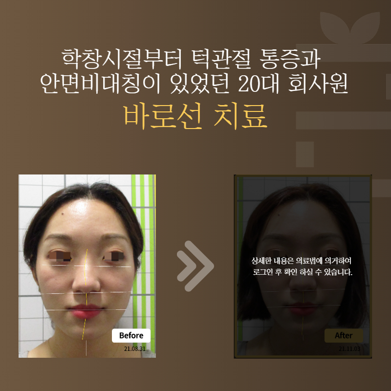 학창시절부터 턱관절 통증과 안면비대칭이 있었던 20대 회사원 바로선치료