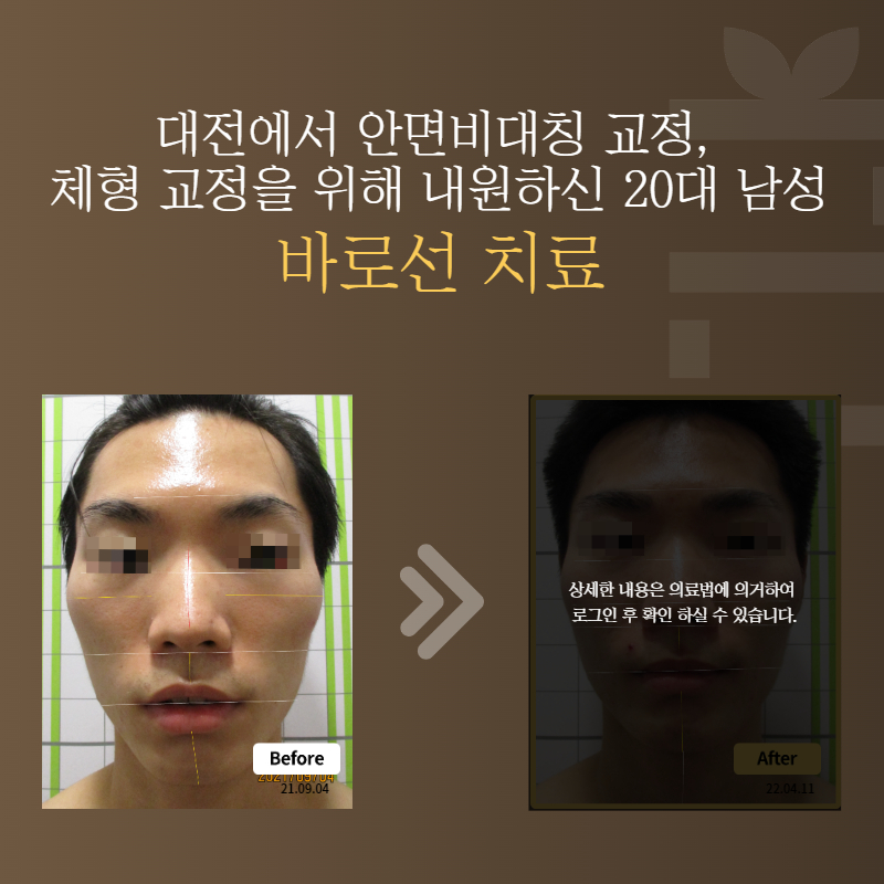 대전에서 안면비대칭 교정, 체형 교정을 위해 내원하신 20대 남성 바로선치료