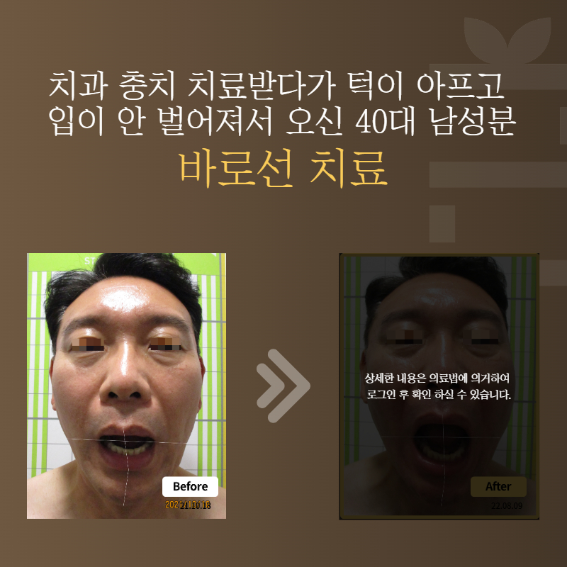 치과 충치 치료받다가 턱이 아프고 입이 안 벌어져서 오신 40대 남성분 바로선치료