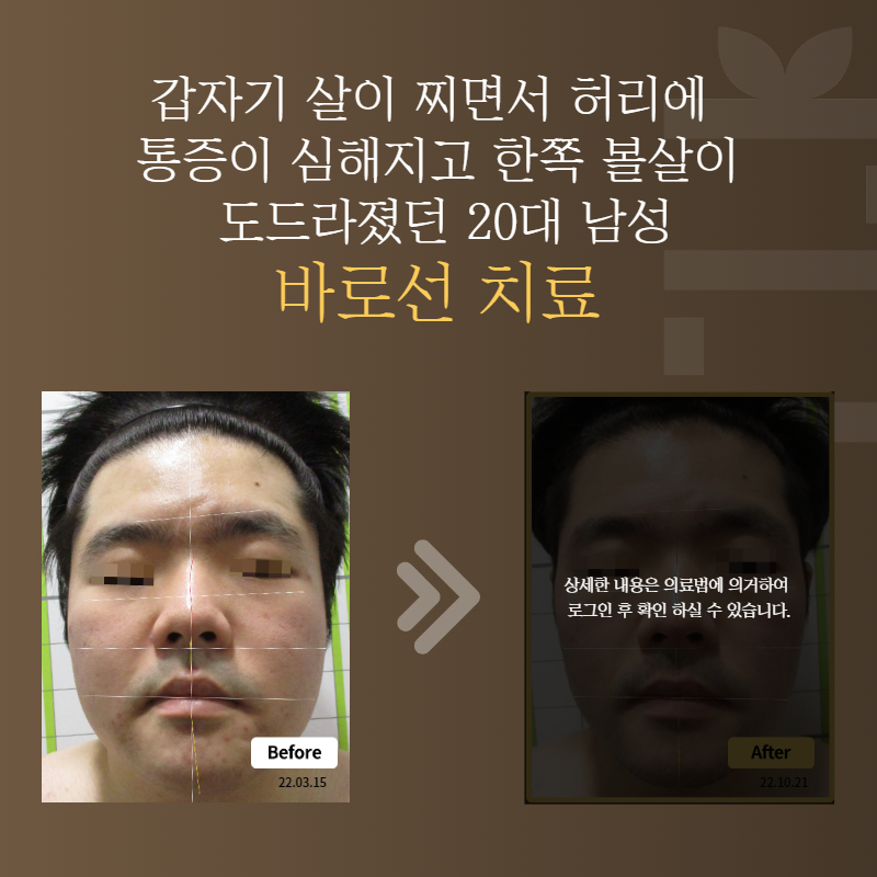 갑자기 살이 찌면서 허리에 통증이 심해지고 한쪽 볼살이 도드라졌던 20대 남성 바로선치료