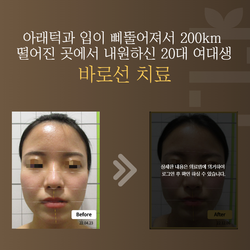 아래턱과 입이 삐뚤어져서 200km 떨어진 곳에서 내원하신 20대 여대생 바로선치료