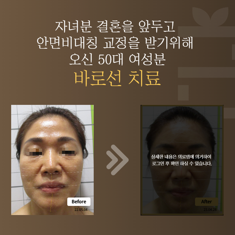 자녀분 결혼을 앞두고 안면비대칭 교정을 받기위해 오신 50대 여성분 바로선치료