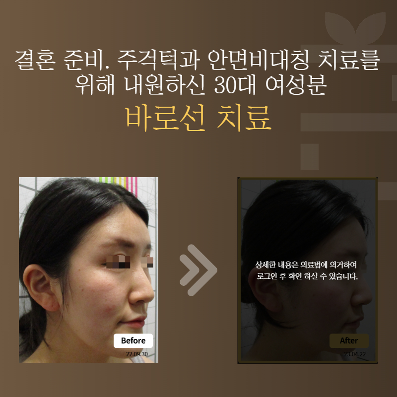 결혼 준비. 주걱턱과 안면비대칭 치료를 위해 내원하신 30대 여성분 바로선치료