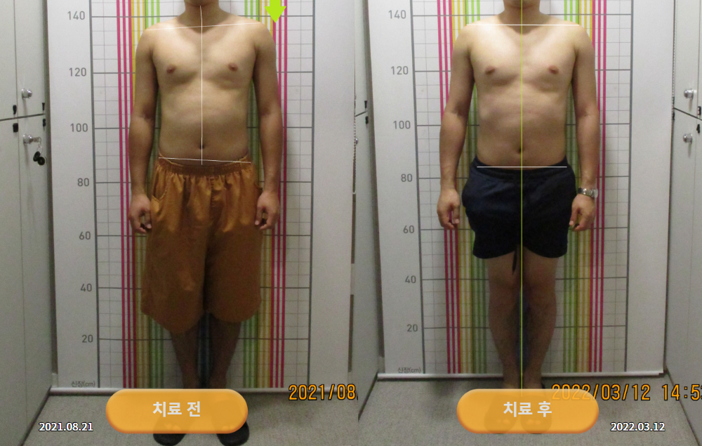 안면비대칭과 턱관절 잡음으로 경북 의성에서 내원하셨던 20대 남성 바로선치료 사진 4