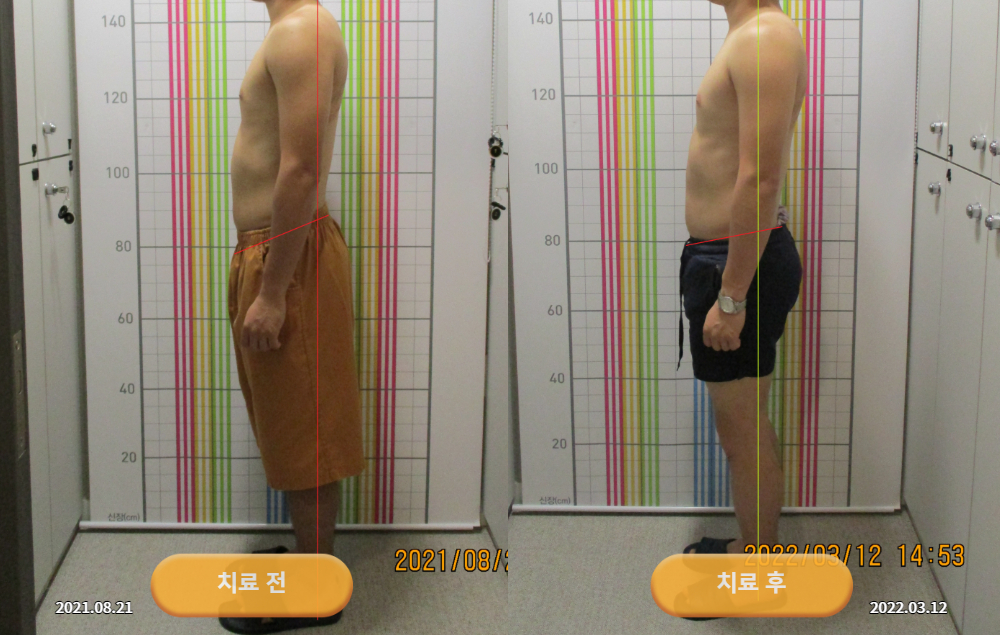 안면비대칭과 턱관절 잡음으로 경북 의성에서 내원하셨던 20대 남성 바로선치료 사진 5