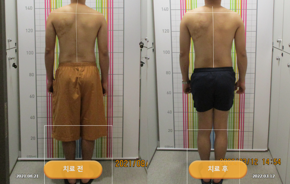 안면비대칭과 턱관절 잡음으로 경북 의성에서 내원하셨던 20대 남성 바로선치료 사진 6