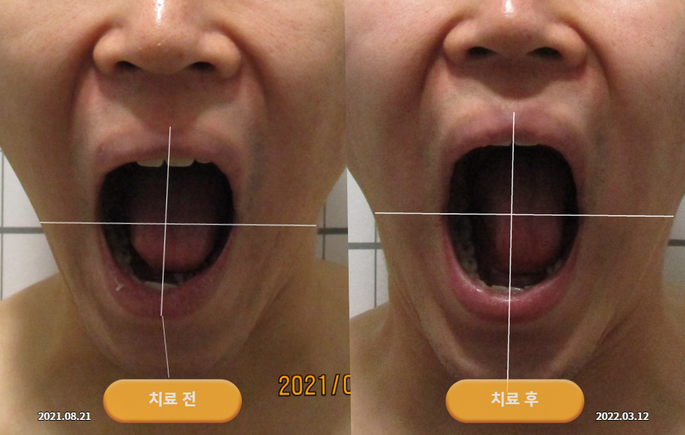안면비대칭과 턱관절 잡음으로 경북 의성에서 내원하셨던 20대 남성 바로선치료 사진 2
