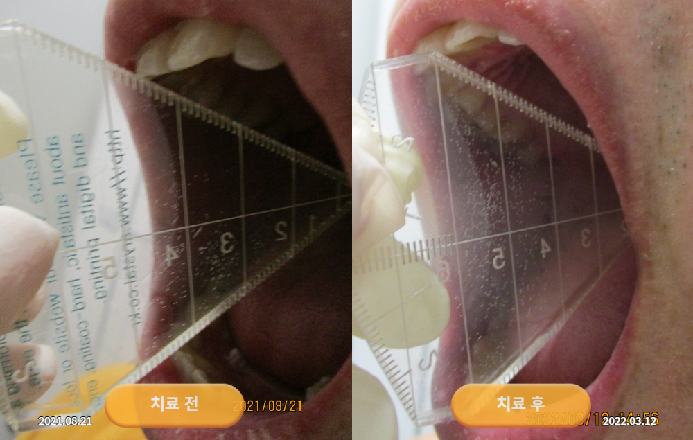 안면비대칭과 턱관절 잡음으로 경북 의성에서 내원하셨던 20대 남성 바로선치료 사진 3