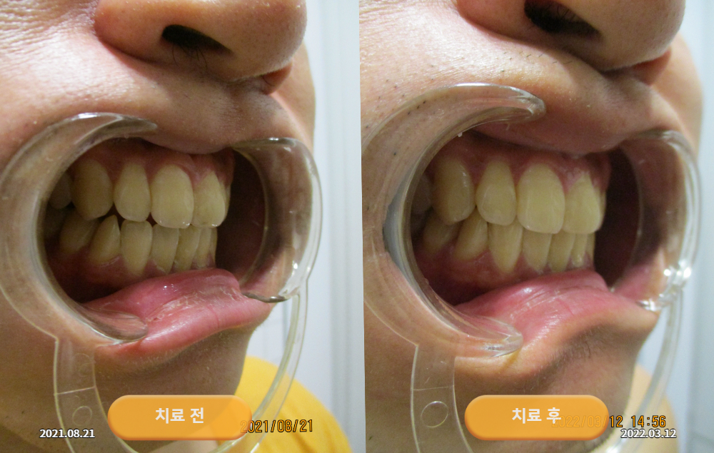안면비대칭과 턱관절 잡음으로 경북 의성에서 내원하셨던 20대 남성 바로선치료 사진 7